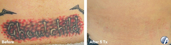 Rapid Laser Tattoo Removal Before & After Results Salinas and Monterey
