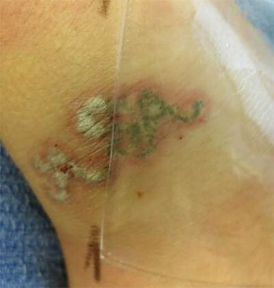 Rapid Laser Tattoo Removal