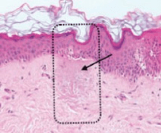 layers of the skin and heated by laser fire