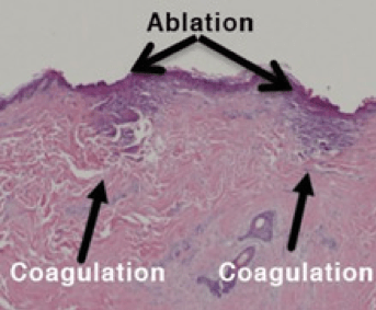 ablation-Sciton JOULE™ Laser